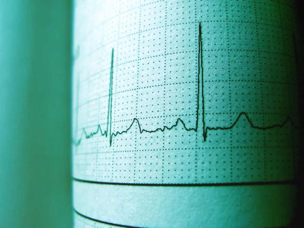 Panic Attacks and the Nervous System | Why the Body Sounds the Alarm 1 ECG heartbeat trace printed on graph paper